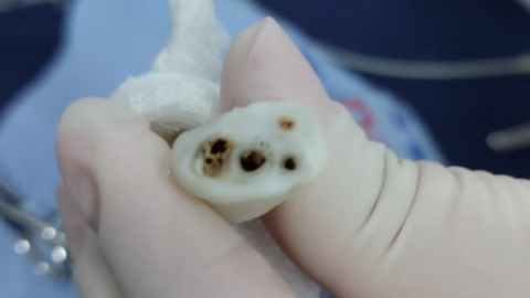 Cateterismo Umbilical