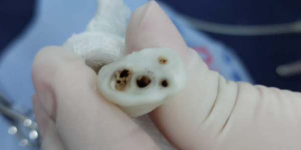 Cateterismo Umbilical